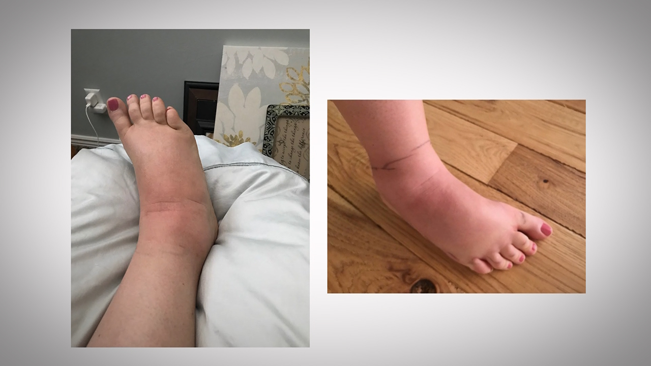 Lisa Zollinger's foot began to redden and swell. Photo: KSL TV