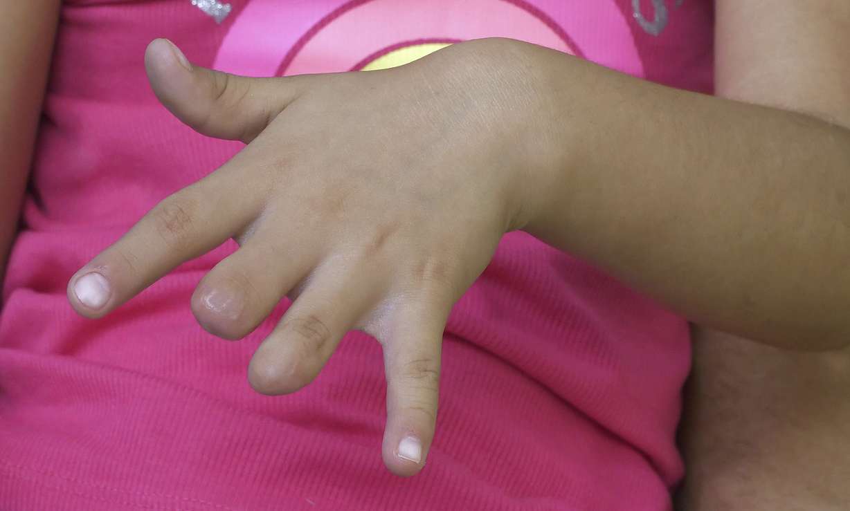 Adalene Moreno's hand is shown during an interview Wednesday, Aug. 1, 2018, in Sandy, Utah. (Photo: Rick Bowmer, AP)