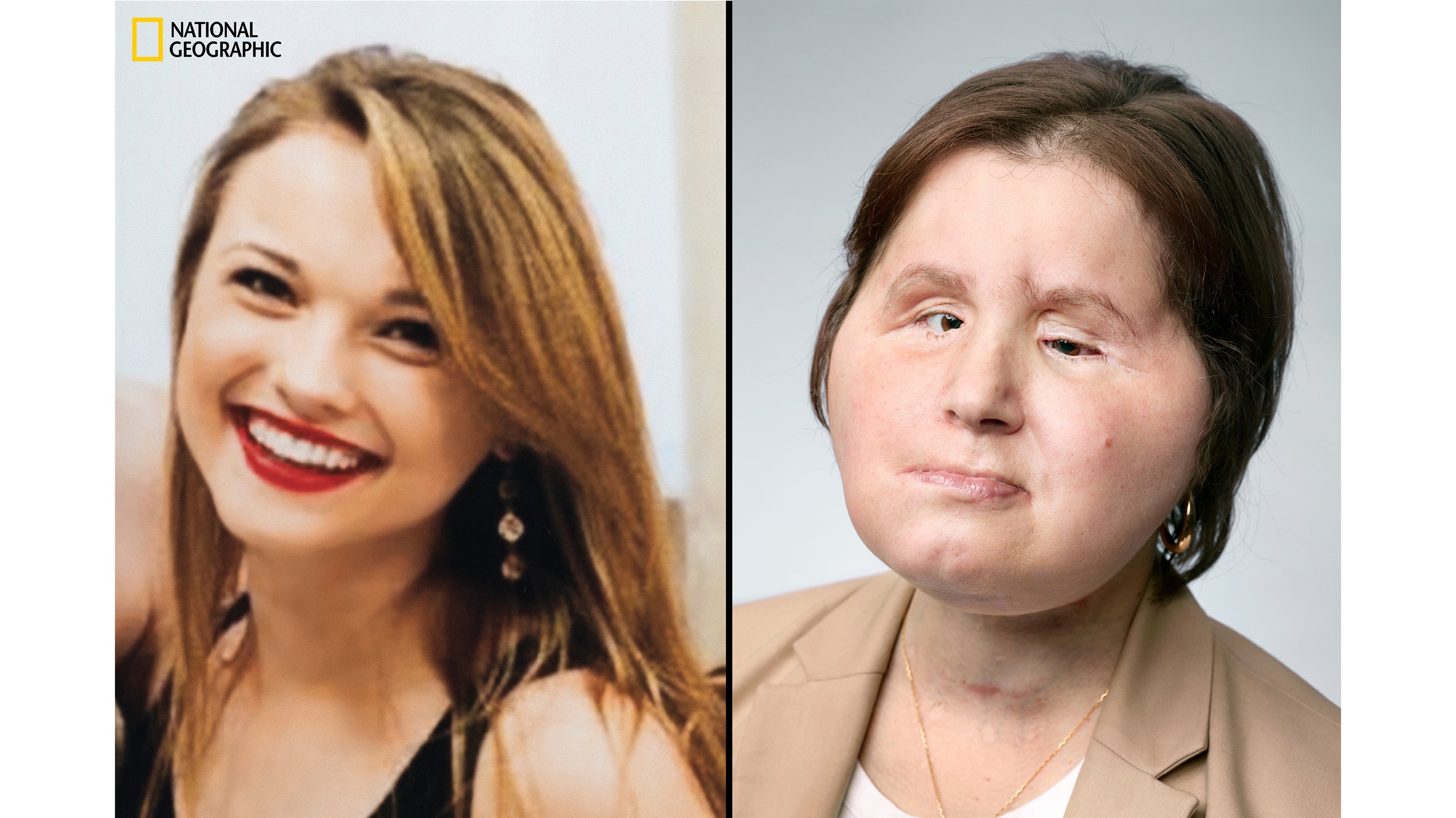 Historic face transplant gives suicide survivor a 'second chance'