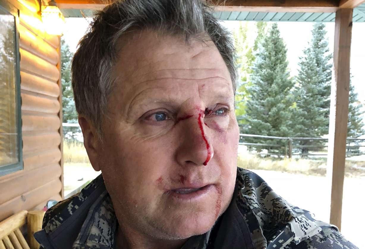 This photo provided by Bob Legasa shows him after a bear attack near Livingston, Mont., Saturday, Oct. 13, 2018. Legasa, who is having a second surgery for his injuries Monday, Oct. 15,2018, says he expects to be discharged Tuesday, three days after he was mauled by a grizzly sow protecting her cub. (Bob Legasa via AP)