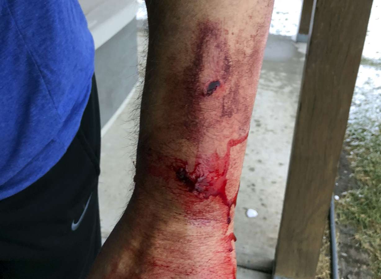 This photo provided by Bob Legasa shows his arm after a bear attack near Livingston, Mont., Saturday, Oct. 13, 2018. Legasa, who is having a second surgery for his injuries Monday, Oct. 15,2018, says he expects to be discharged Tuesday, three days after he was mauled by a grizzly sow protecting her cub. (Bob Legasa via AP)