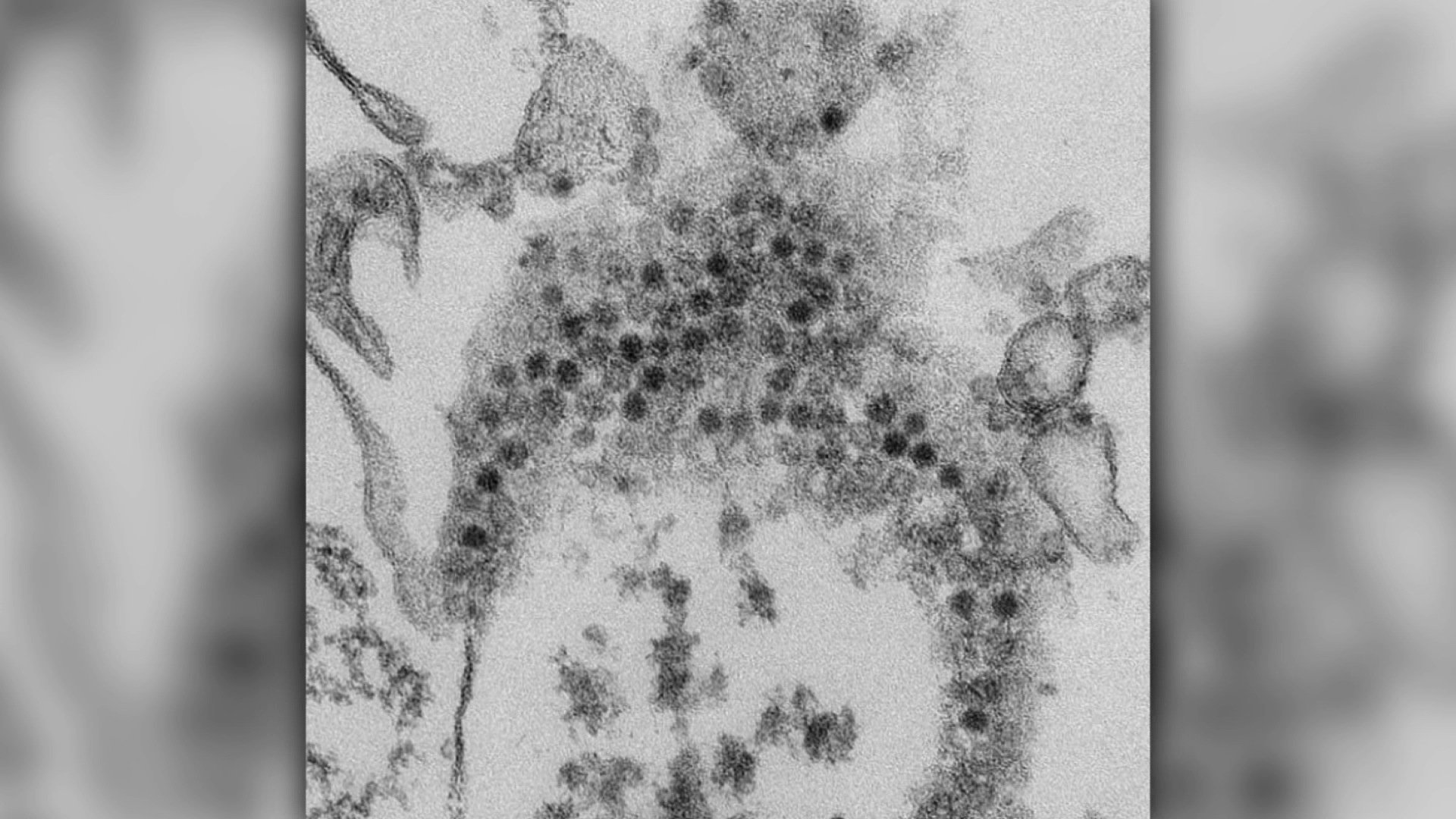 127 cases of polio-like illness under investigation, CDC says