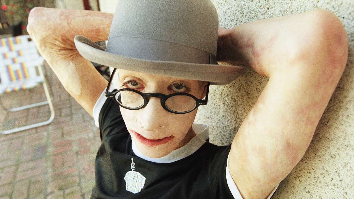 Dave Dave, who was set afire as boy, died of natural causes