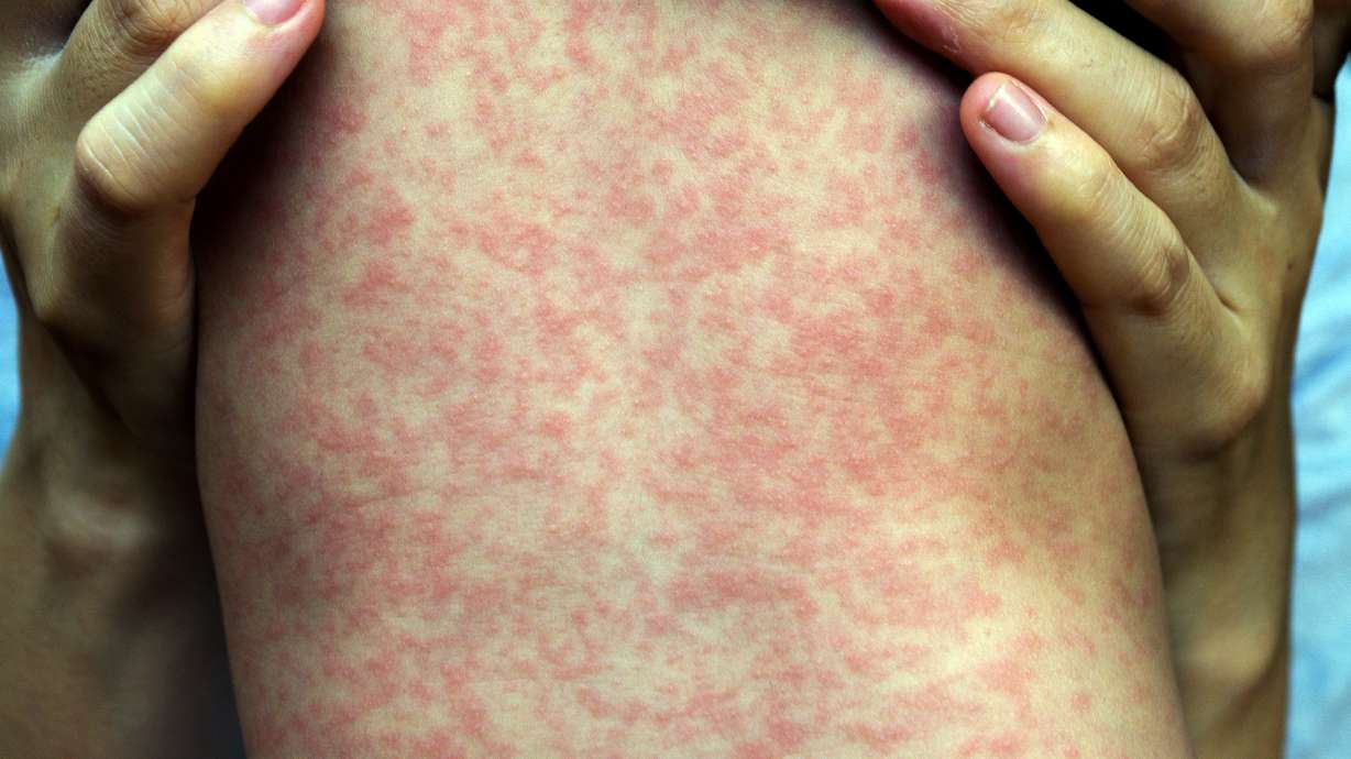 Utah health officials on Wednesday said they are "closely watching" another potential measles situation in the southwestern part of the state.