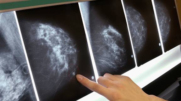 FDA proposes changes to mammography standards for first time in more than 20 years