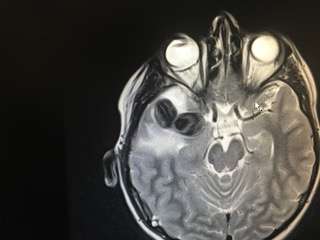Scan of Tate Erickson's brain after suffering a concussion. (Photo: Courtesy: Erickson family)