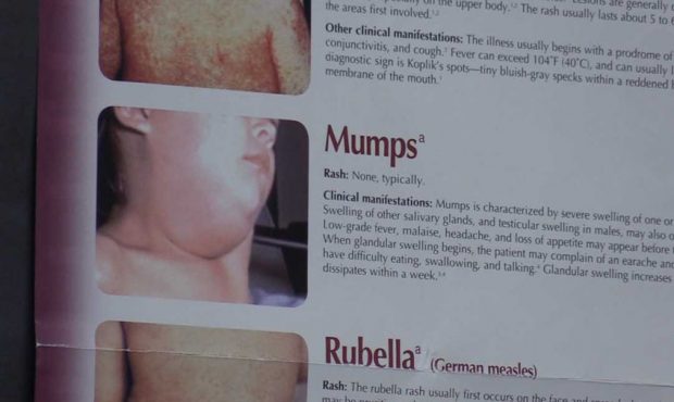 New cases of mumps confirmed in Sanpete County