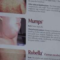New cases of mumps confirmed in Sanpete County
