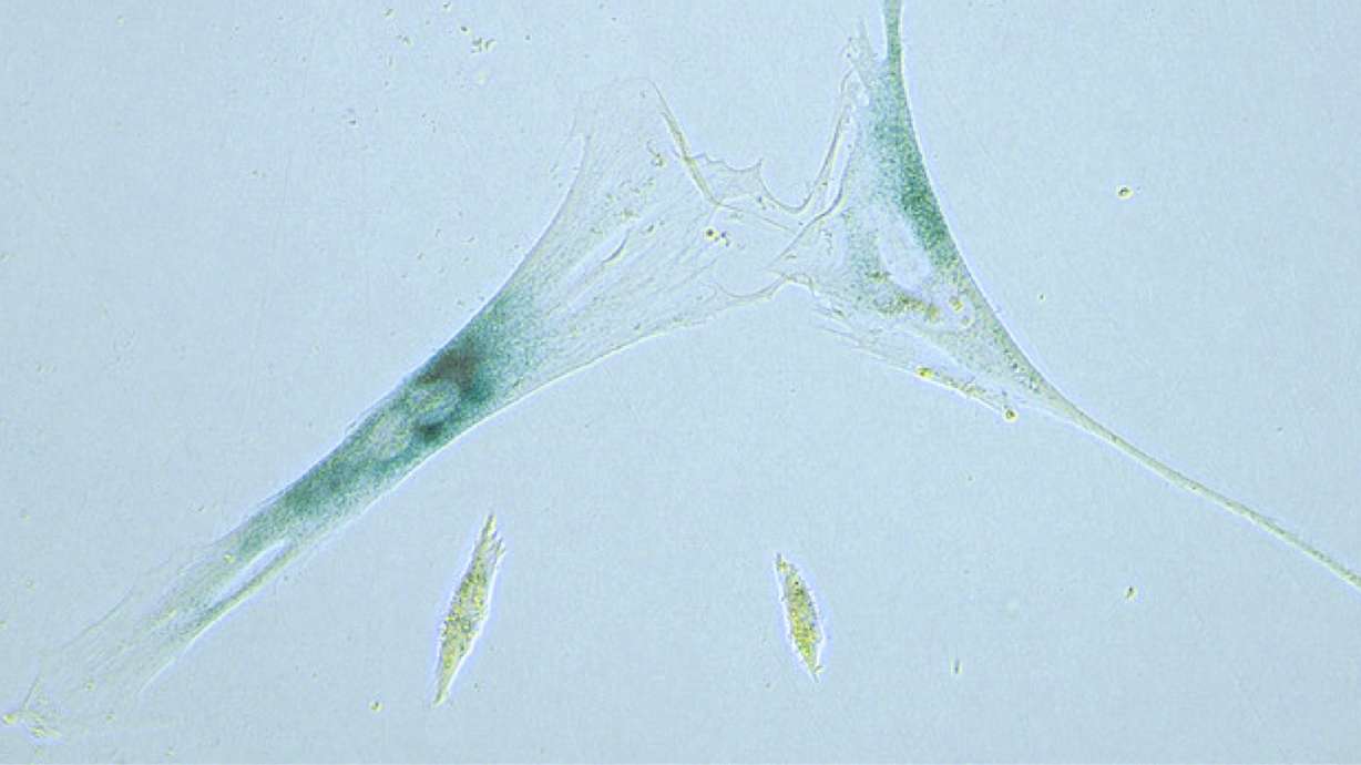 'Zombie cells' buildup in your body may play role in aging