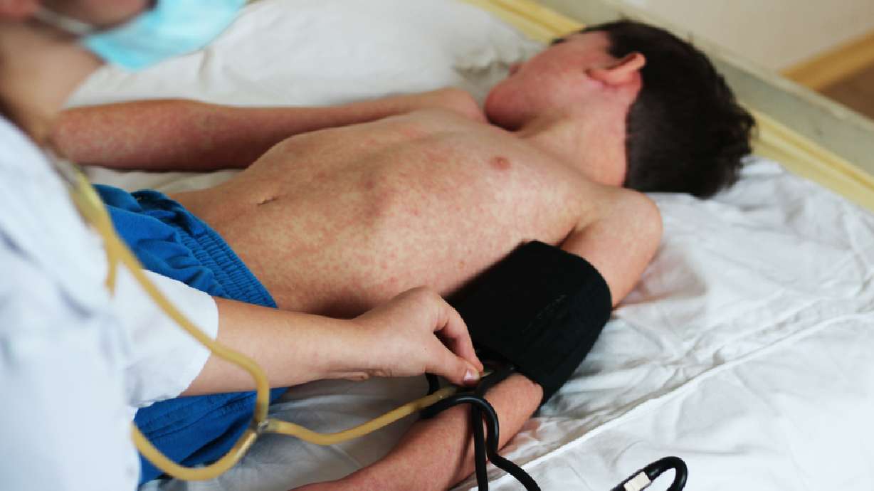 What you need to know about measles