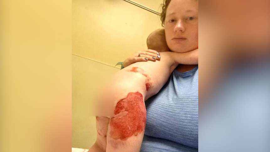 Millie Camp suffered severe burns from a roasting pan.(Photo: Courtesy Camp family via EastIdahoNews.com)