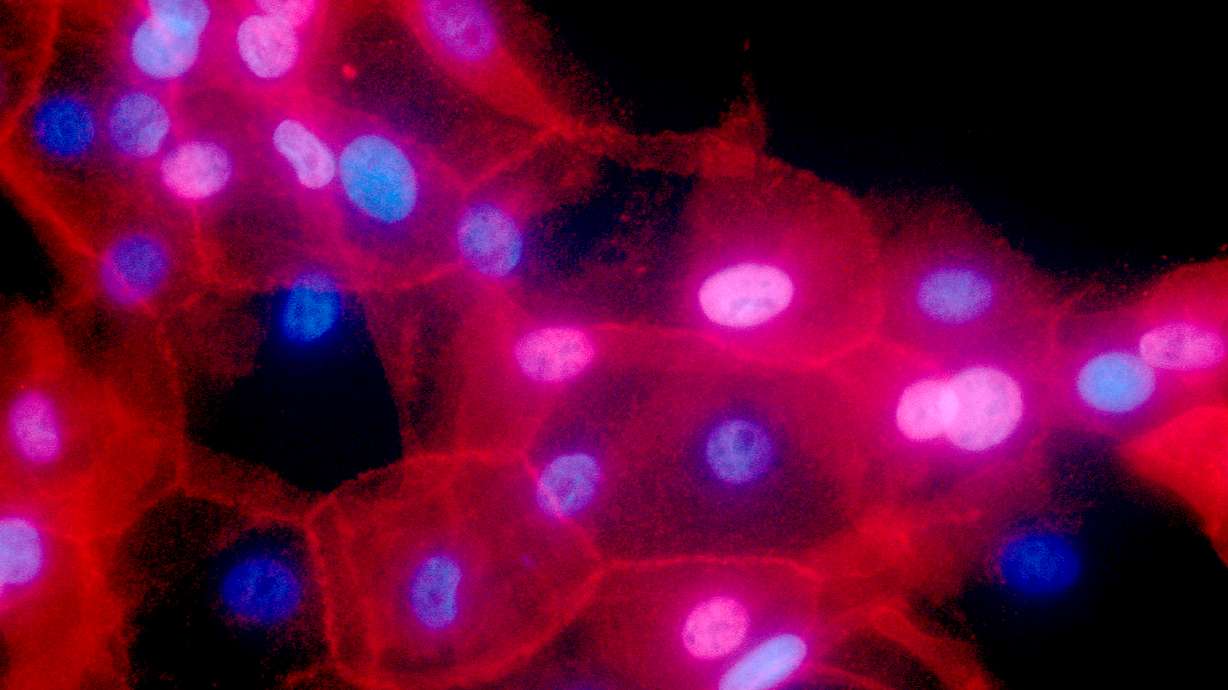 Guidelines say more women may need breast cancer gene test