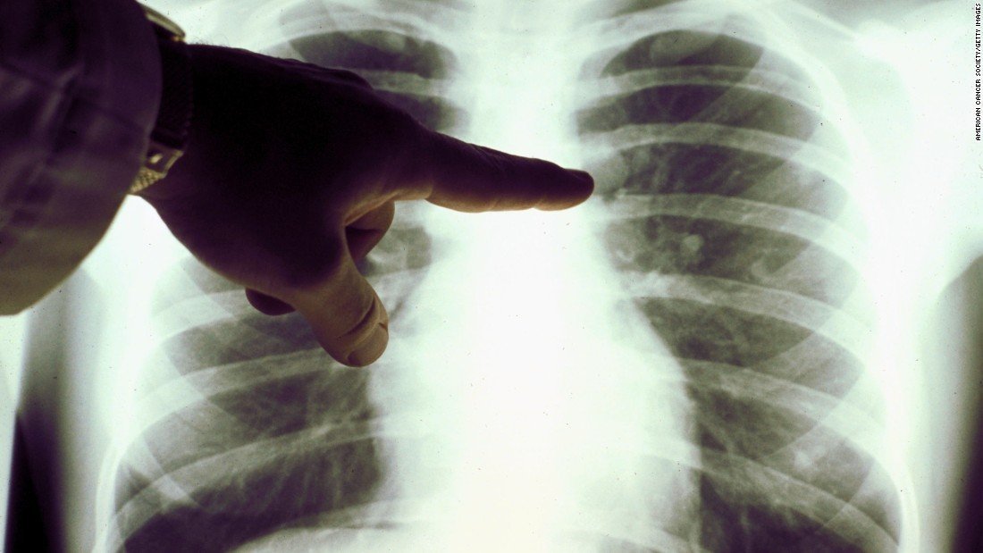 More people are surviving lung cancer in the US, report finds