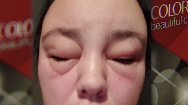 Severe allergic reaction to expired hair dye hospitalizes Magna woman |  KSL.com Severe allergic reaction to expired hair dye hospitalizes Magna woman |  KSL.com