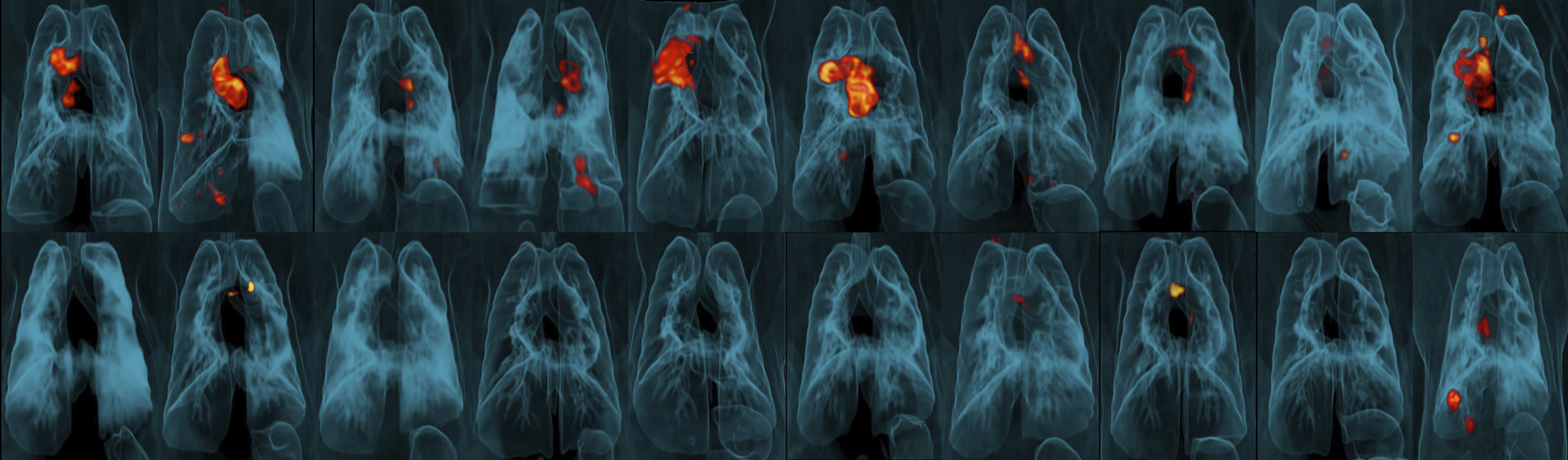 Century-old TB vaccine may work better if given in a new way