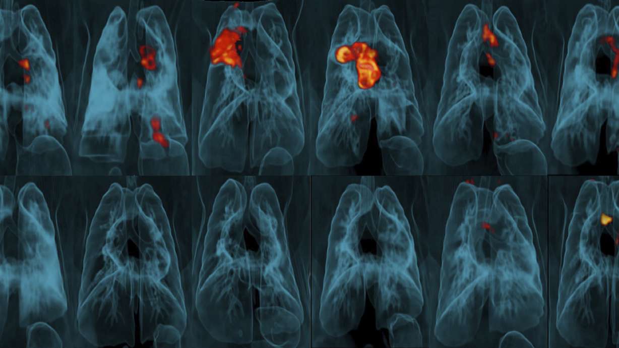 Century-old TB vaccine may work better if given in a new way