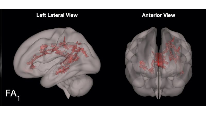 The red shows the increase in organized white matter in the language centers of the preschooler's brain. (Courtesy Dr. John Hutton, Cincinnati Children's Hospital via CNN) - Courtesy Dr. John Hutton, Cincinnati Children's Hospital via CNN
