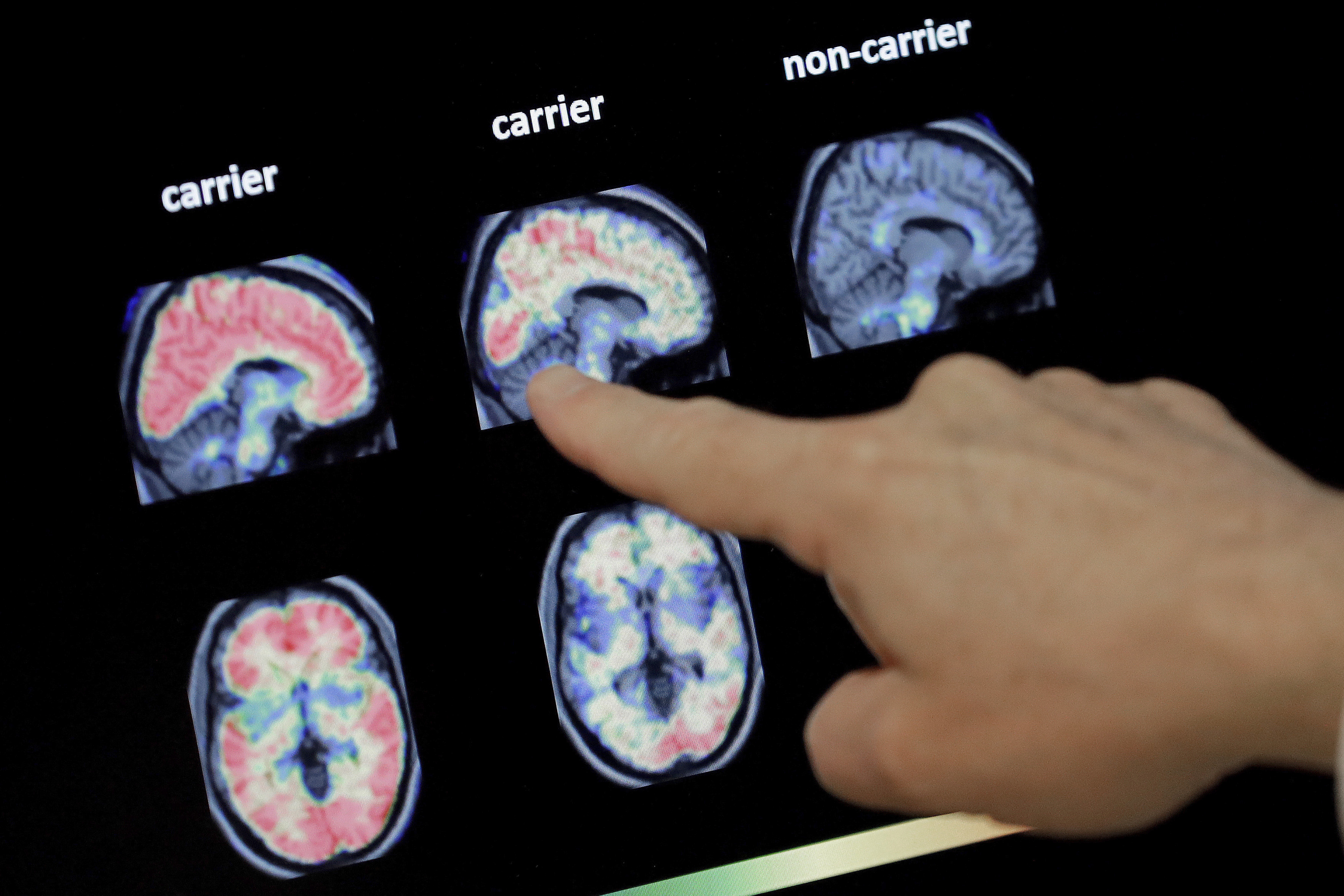 Drugs fail to slow decline in inherited Alzheimer's disease