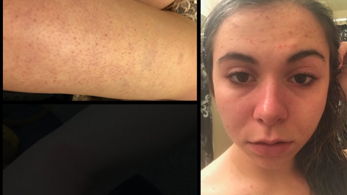 “I started getting skin rashes and getting a lot of bruises,” Ashley Cox said. “I started going numb in my hands and my feet.” Photo: KSL TV