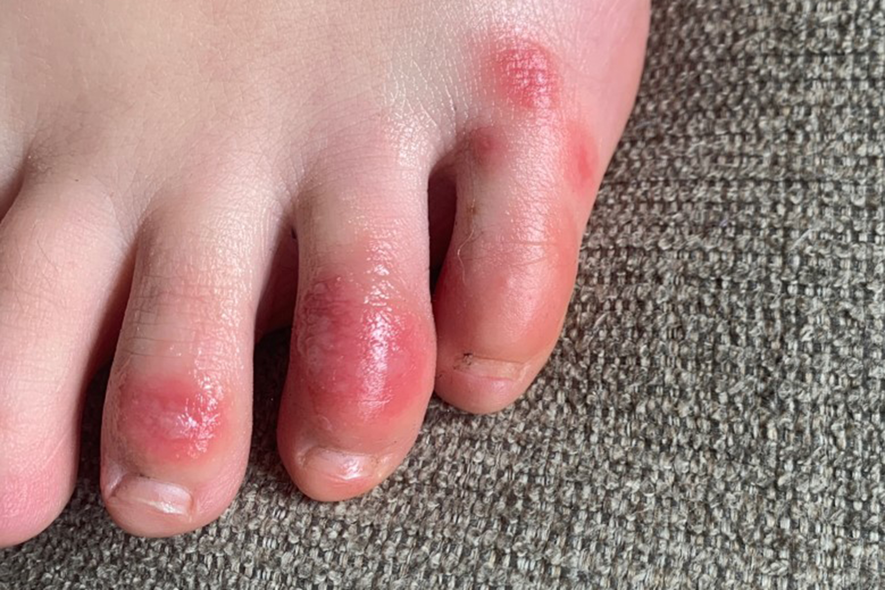 'COVID toes,' other rashes latest possible rare virus signs