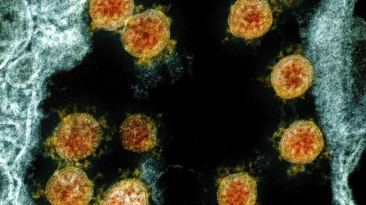This electron microscope image made available and color-enhanced by the National Institute of Allergy and Infectious Diseases Integrated Research Facility in Fort Detrick, Md., shows Novel Coronavirus SARS-CoV-2 virus particles, orange, isolated from a patient. (NIAID/National Institutes of Health via AP)