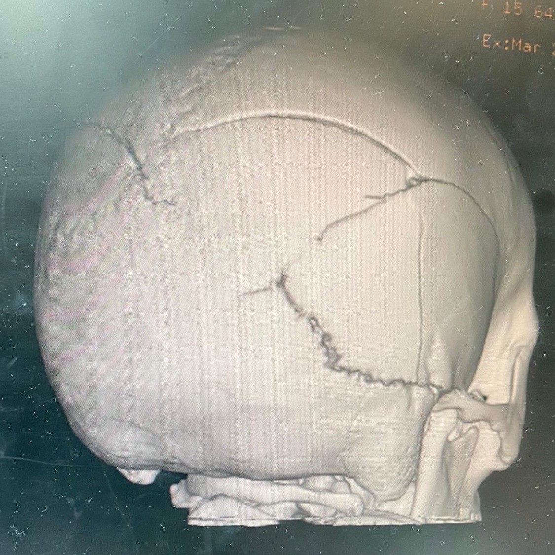 Bri Money fell on her head and suffered a severe traumatic brain injury and cracked her skull. (Photo: KSL TV)