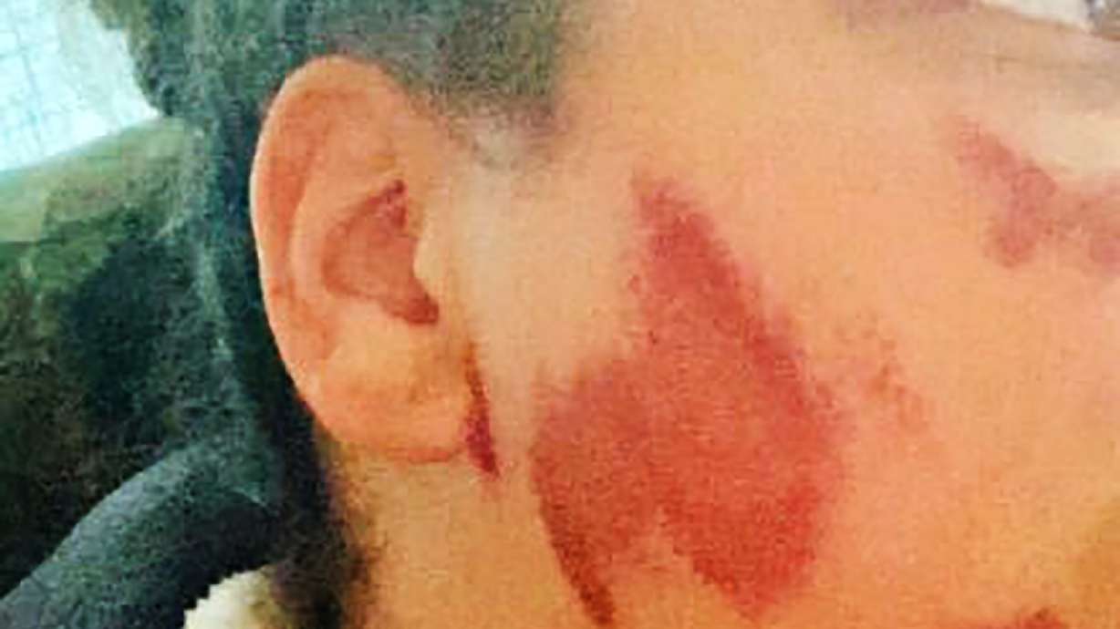 Wisconsin woman wants burn attackers to know they hurt her