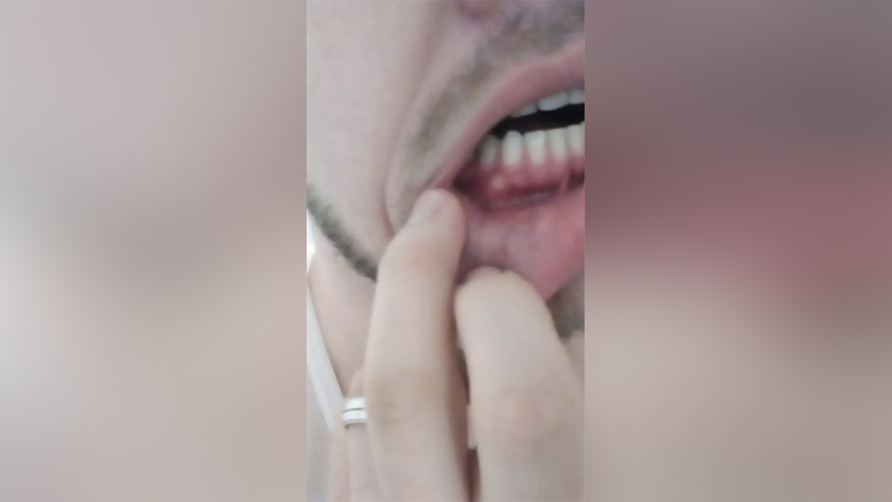 Josh Holt took this photo of his infected gums to show his family the botched dental work he endured in prison.