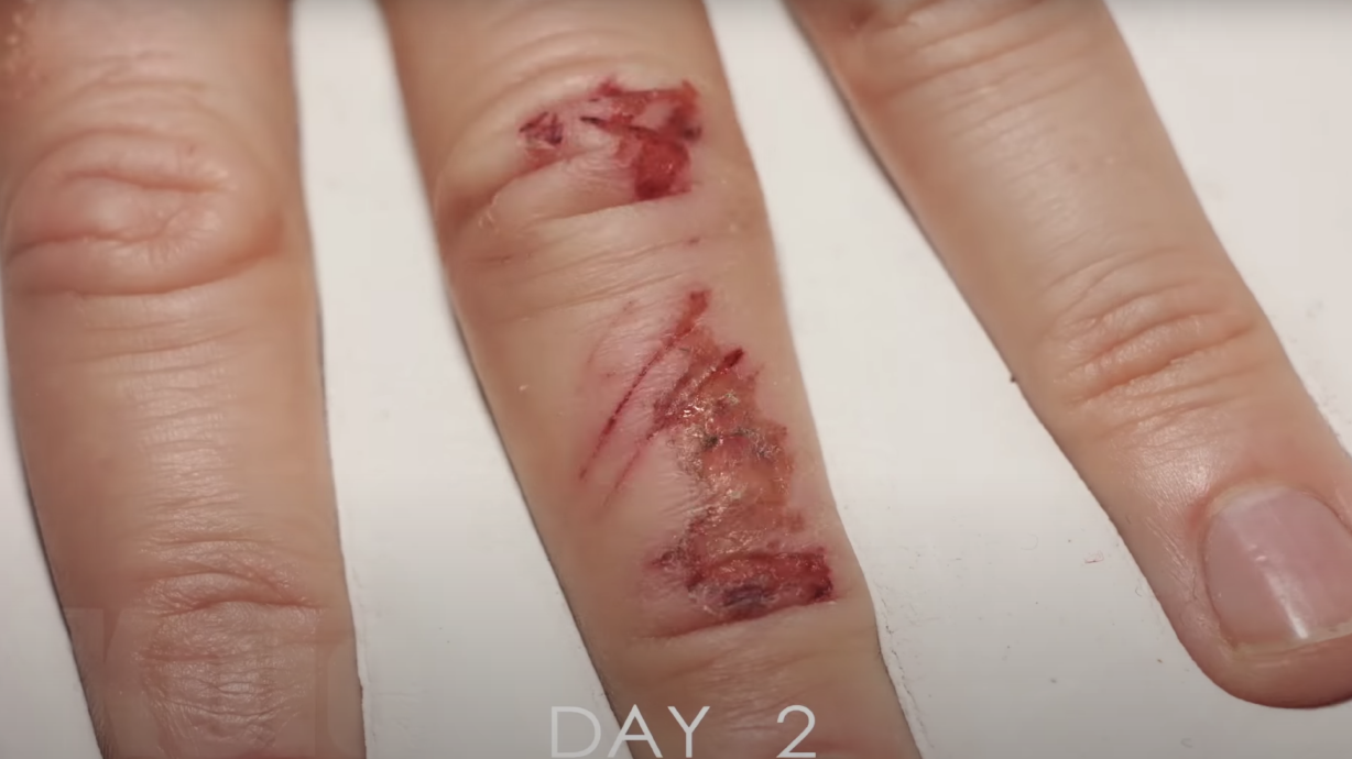 Have You Seen This? Borderline gross, but amazing time lapse of a healing wound
