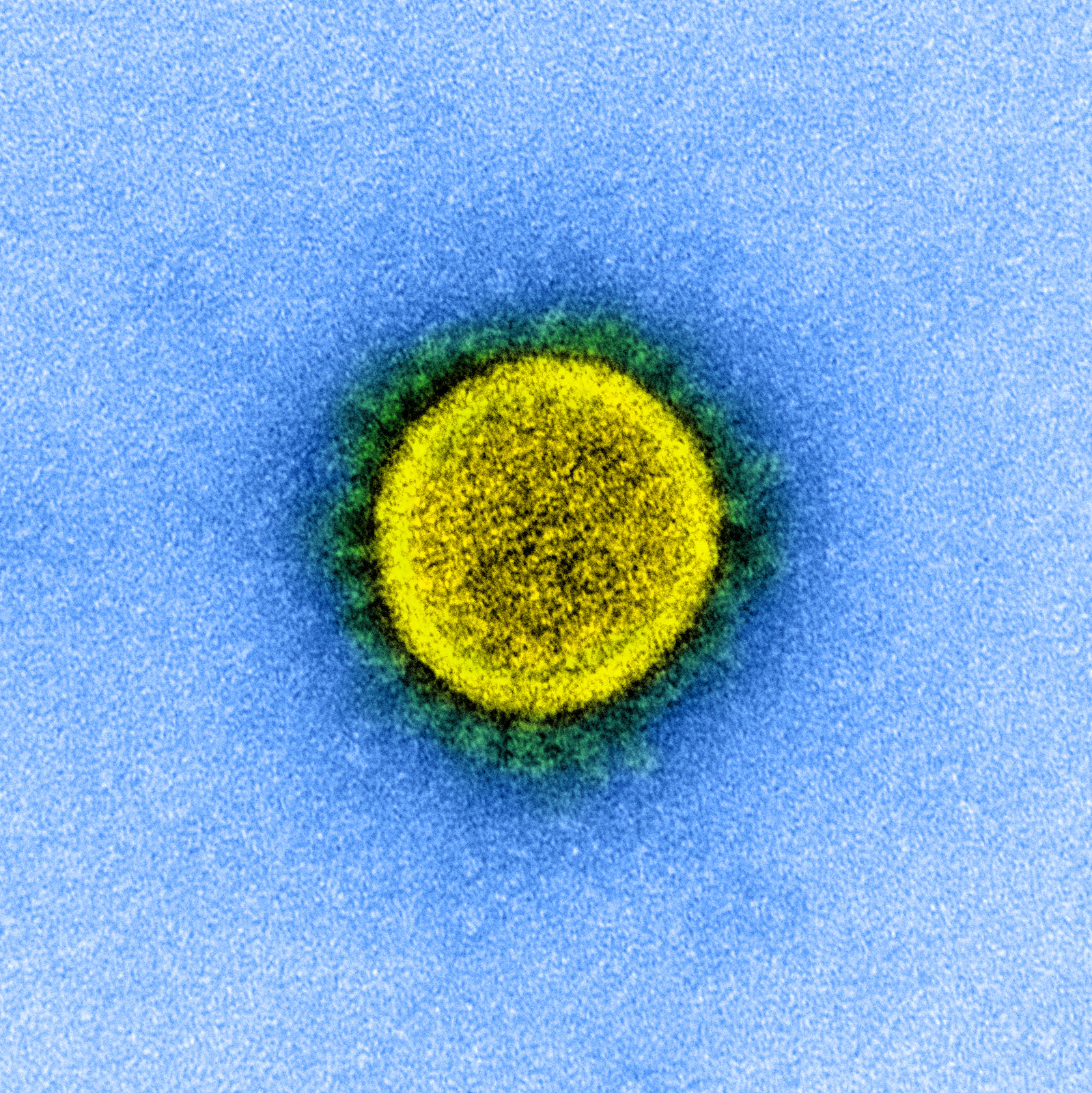 Transmission electron micrograph of a SARS-CoV-2 virus, isolated from a patient.