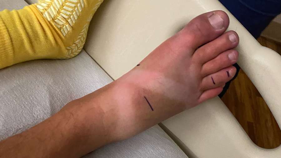 A snake bite caused Ashton Morrell's foot to swell.