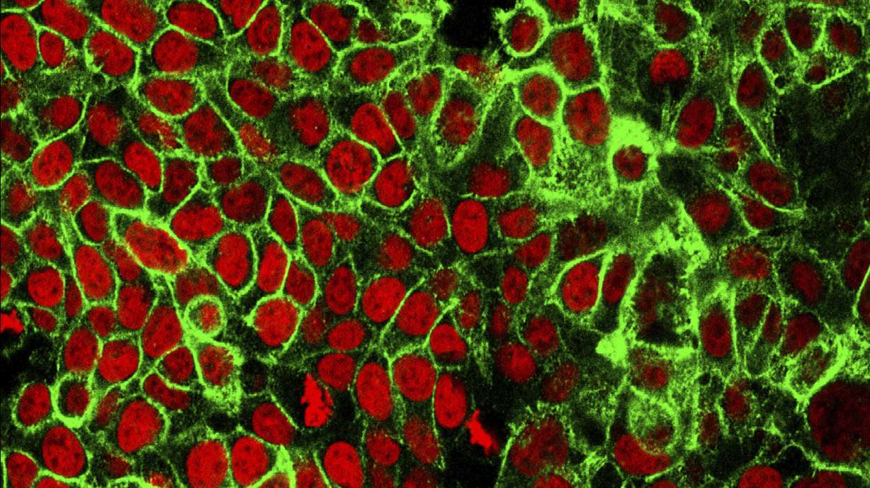 This microscope image made available by the National Cancer Institute Center for Cancer Research in 2015 shows human colon cancer cells with the nuclei stained red. Adults across the United States are being diagnosed with colon and rectal cancers at younger ages.