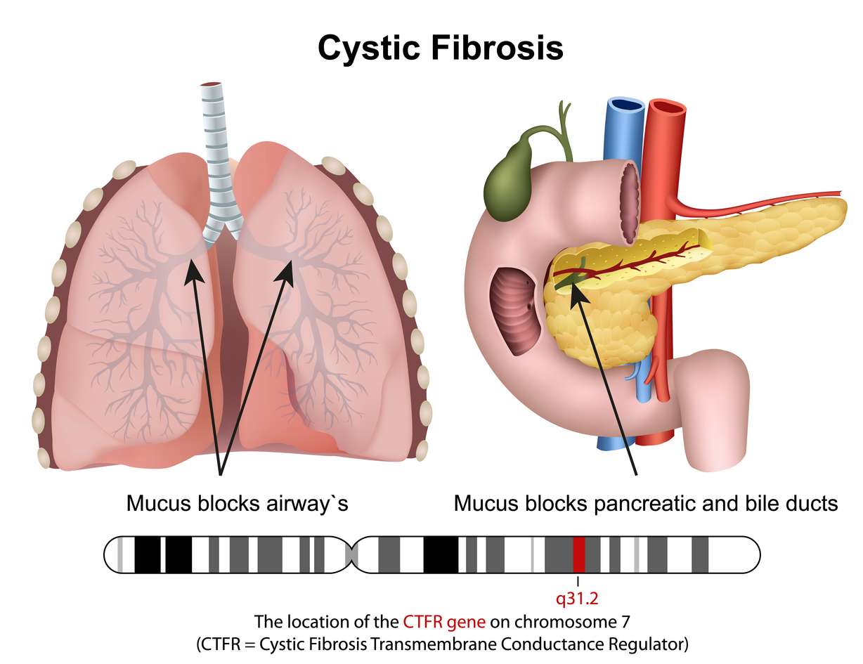 How you can help save lives by participating in a free Utah virtual auction for cystic fibrosis