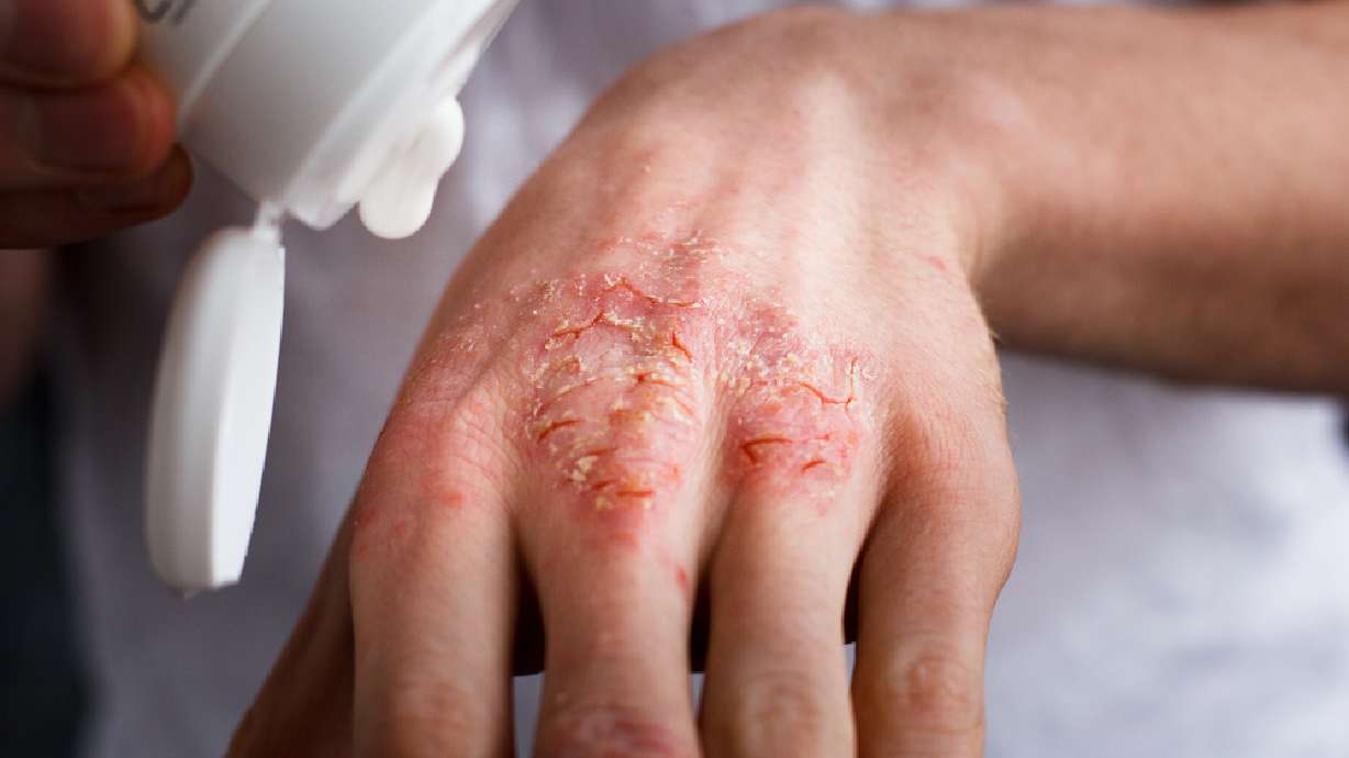 Dermatologists have new, more effective ways of treating severe eczema