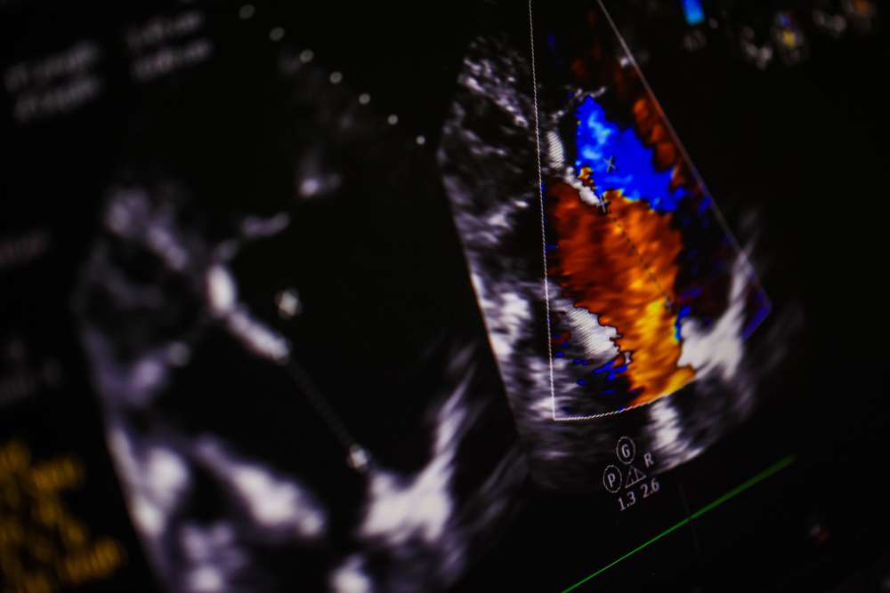 How one Utah woman developed a heart murmur after getting a strep infection