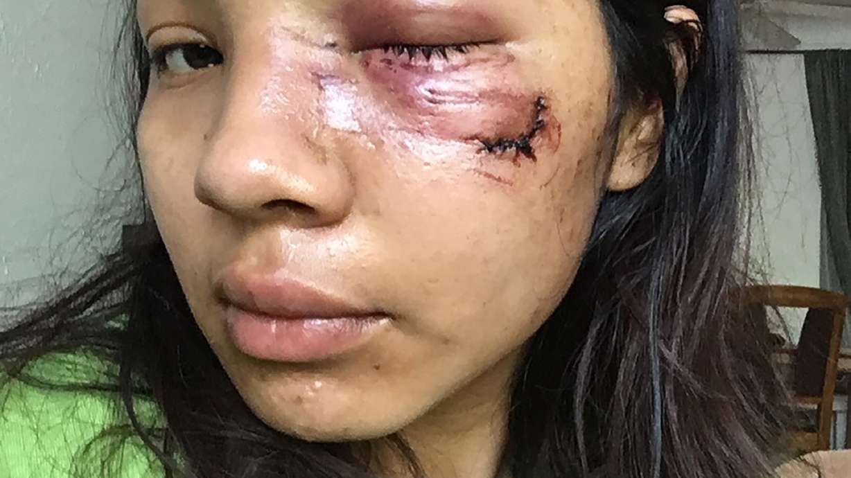 Woman injured by police during Floyd unrest settles lawsuit