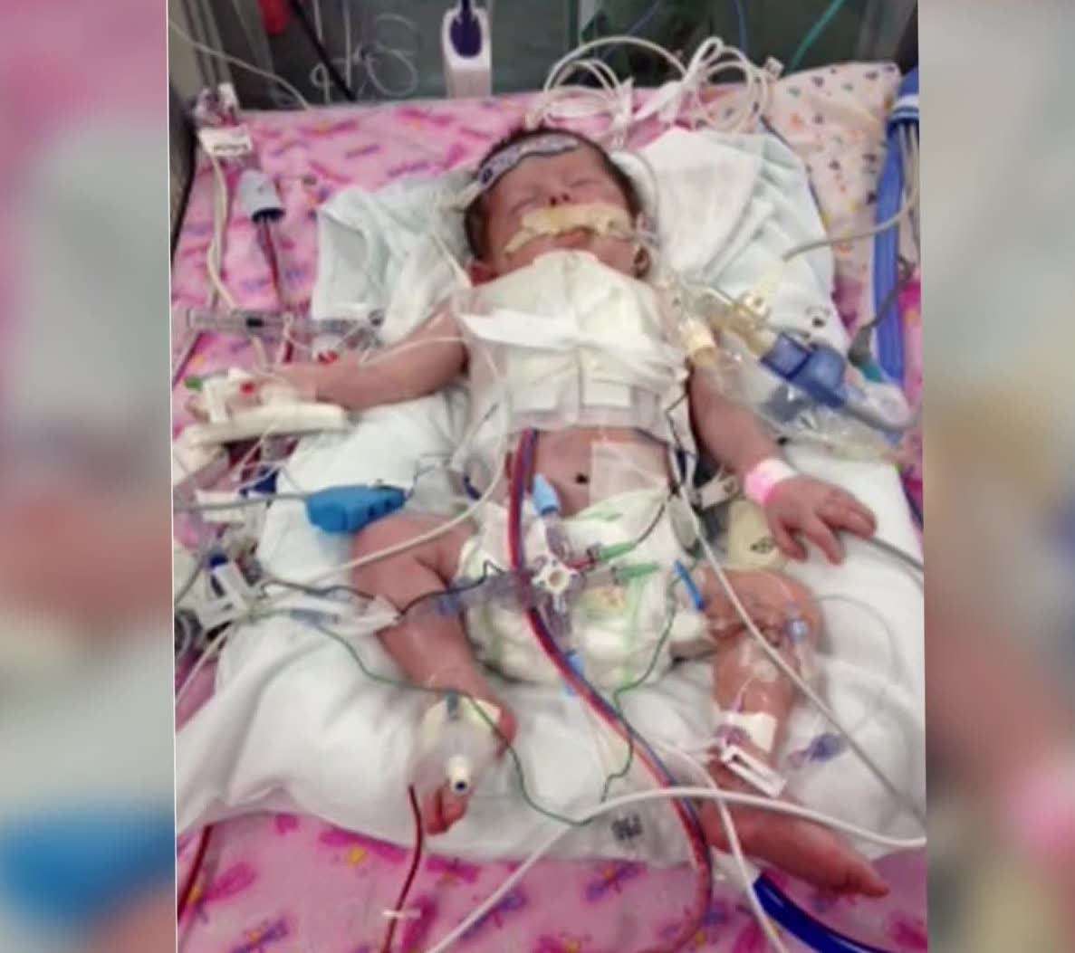 Callie's first surgery was days after she was born.