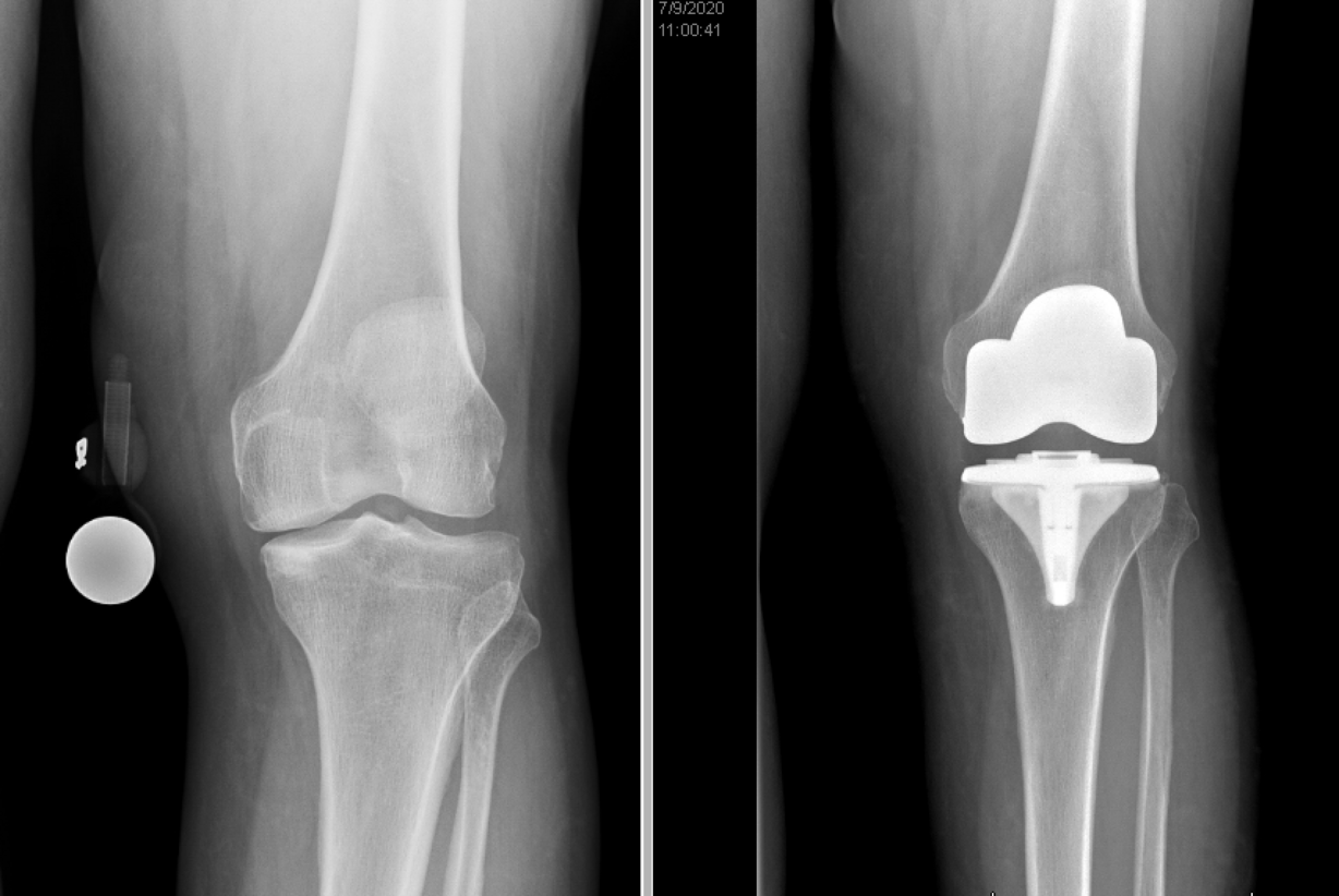 A Utah man's experience with how COVID-19 has impacted joint replacements