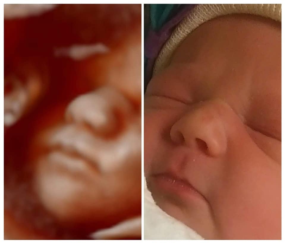 Here is a 4D image next to a photo of the same infant after birth.