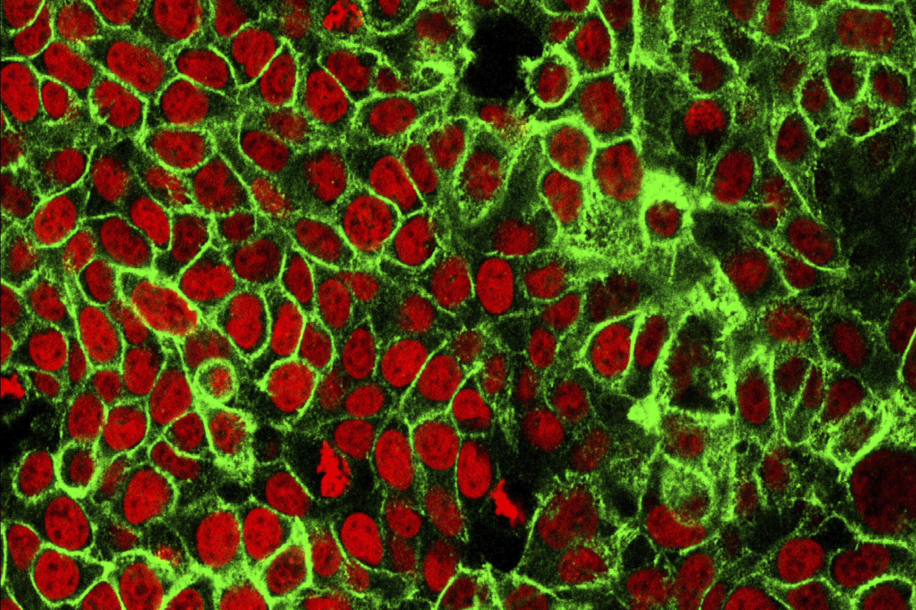FILE - This microscope image made available by the National Cancer Institute Center for Cancer Research in 2015 shows human colon cancer cells with the nuclei stained red. Americans should start getting screened for colon cancer earlier, at age 45 instead of waiting until they're 50, according to new guidelines from the U.S. Preventive Services Task Force, released on Tuesday, May 18, 2021. (NCI Center for Cancer Research via AP, File)