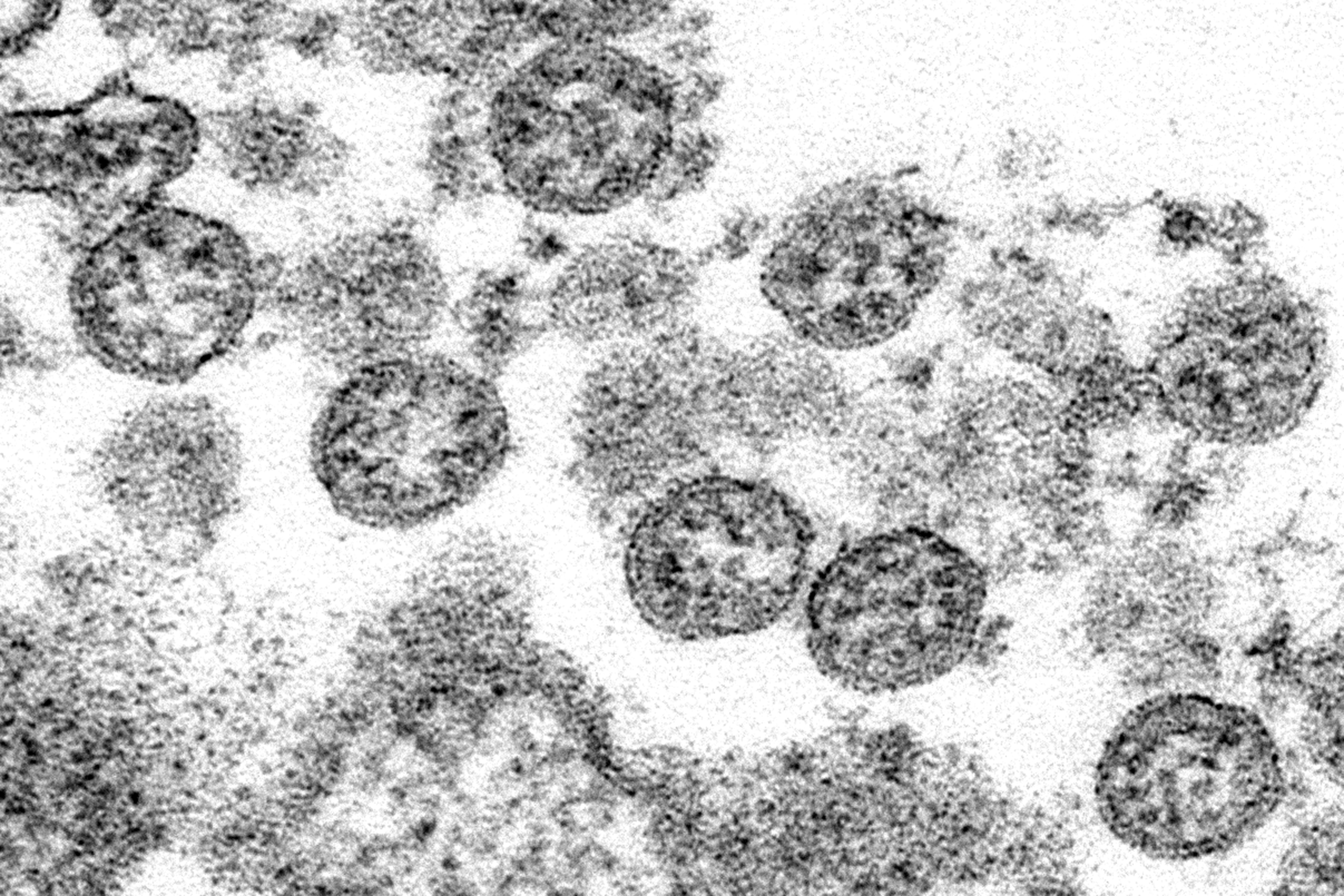 This 2020 electron microscope image made available by the U.S. Centers for Disease Control and Prevention shows the spherical coronavirus particles from what was believed to be the first U.S. case of COVID-19. A new analysis of blood samples from 24,000 Americans taken in early 2020 is the latest and largest study to suggest that the coronavirus popped up in the U.S. in December 2019 — weeks before cases were first recognized by health officials.