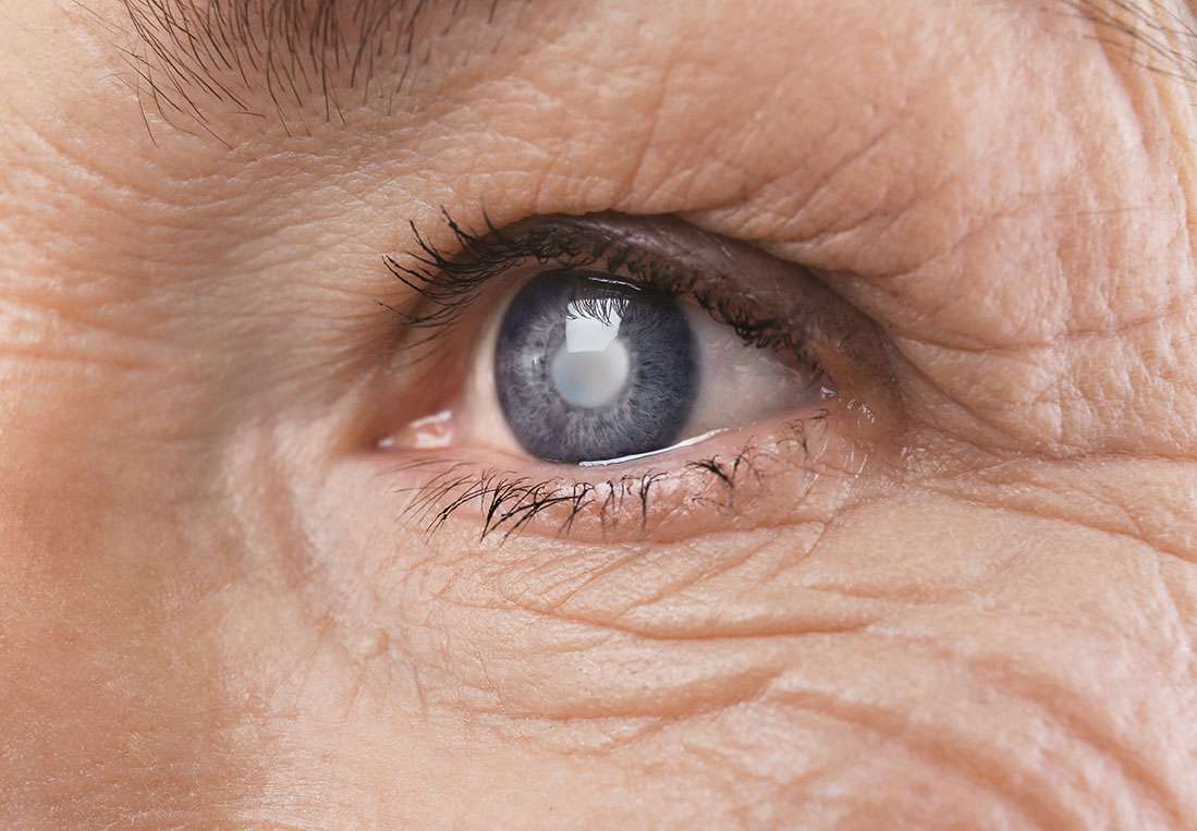 Utah is a hot spot for cataract surgery lens options