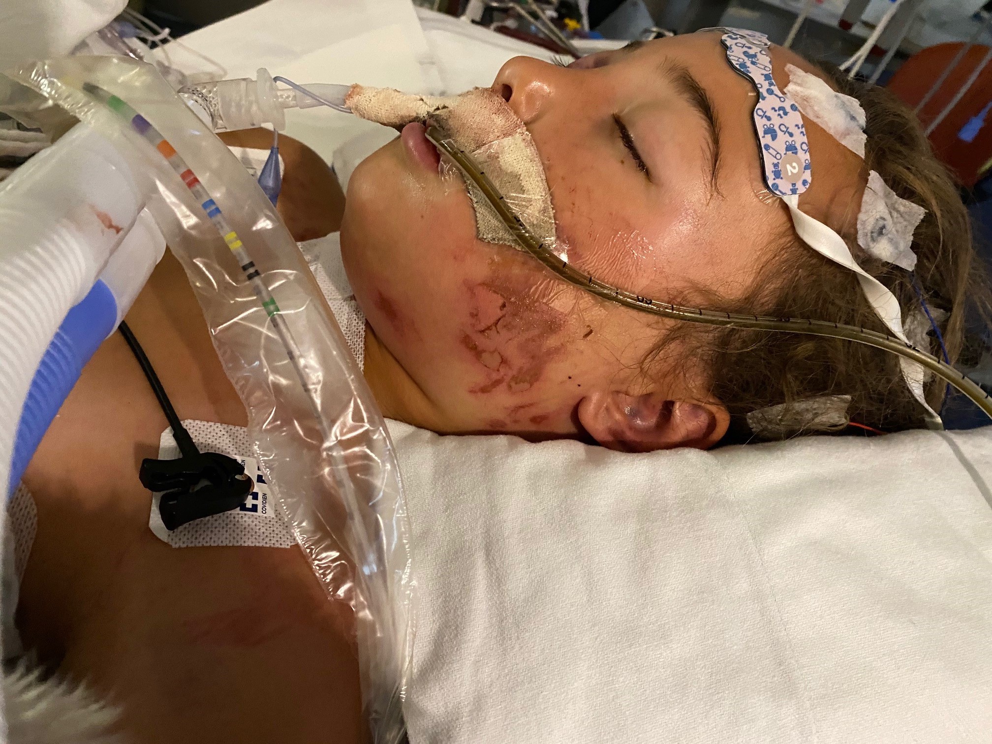 Emelia, 11, recovers at Primary Children's Hospital after getting pinned underneath an ATV earlier this year.