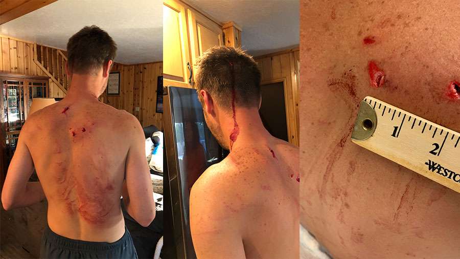 Tom Whitney’s injuries sustained in a grizzly bear attack on Friday, July 9, 2021.