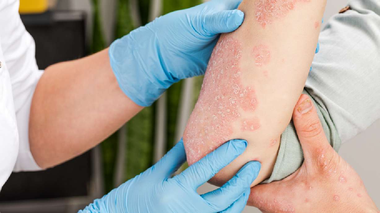 Dermatologists can offer relief for your psoriasis. Here's what you should know