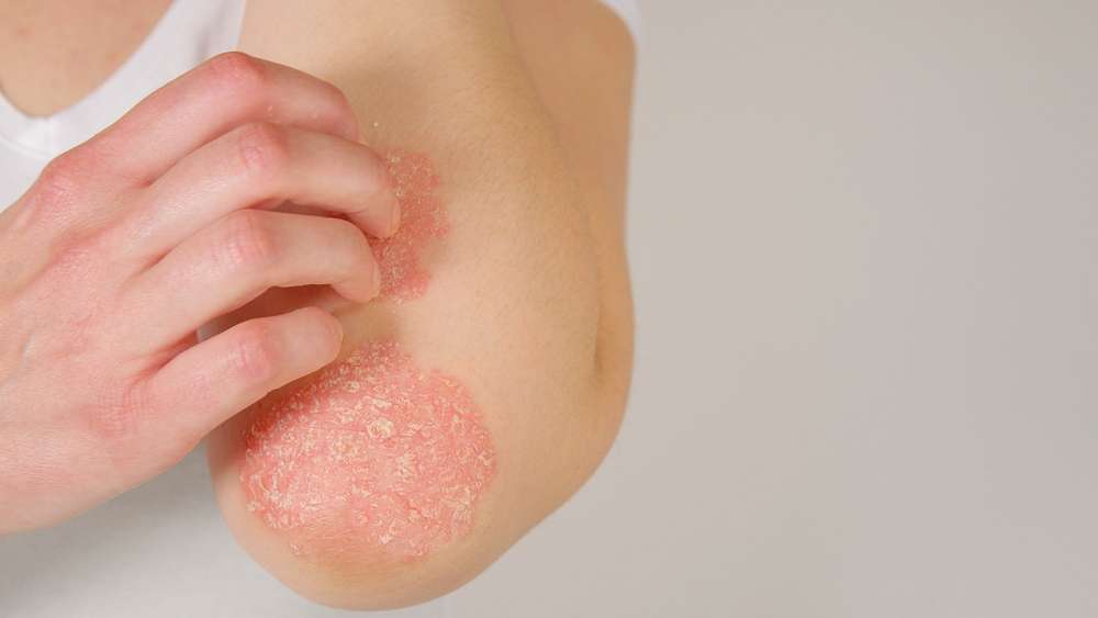 Dermatologists can offer relief for your psoriasis. Here's what you should know