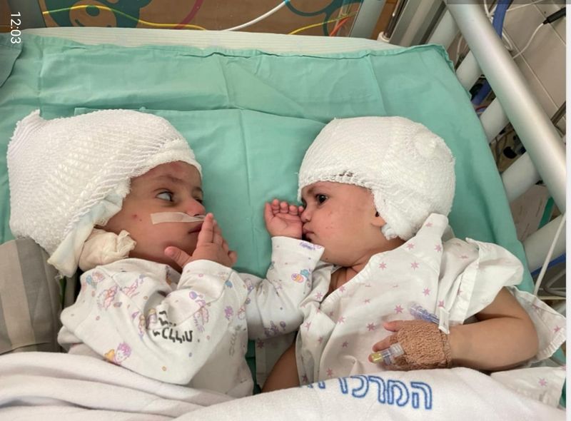 Formerly siamese Israeli twins look at one another after having undergone rare separation surgery at Soroka Medical Centre, in southern Israel on Sunday. The 1-year-old girls, whose names were not released, were born with the rear parts of their heads conjoined.