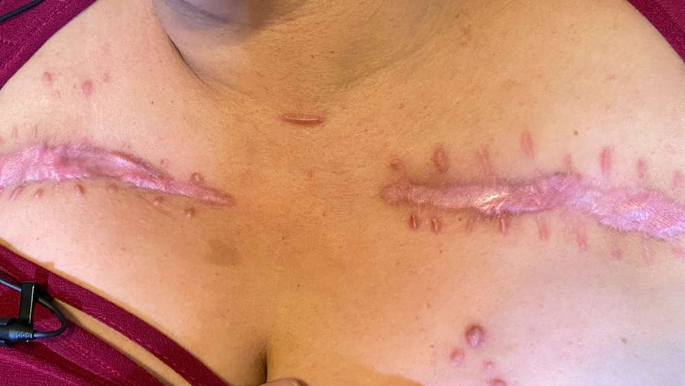 Doctors needed to make incisions on Nancy Hernandez’s body to release air build-up after she was hospitalized with COVID-19.