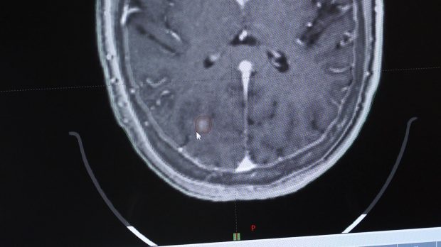 Dr. Jaden Evans, a radiation oncologist at McKay-Dee Hospital in Ogden, uses stereotactic radiosurgery to pinpoint cancerous tumors in Erika Merrill’s brain without damaging the healthy tissue in her brain. He plans the treatment out through programming on his computer before she receives it in person.