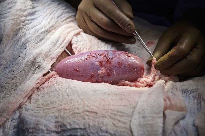 A surgical team at NYU Langone Health examines a pig
kidney attached to the body of a deceased recipient for any signs
of rejection in September 2021. The test was a step in the
decadeslong quest to one day use animal organs for lifesaving
transplants.
